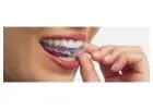 Clear Aligners Treatment in Thane - Agrawal Dental Clinics