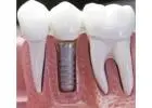 How Do You Maintain Dental Implants, Veneers, and Crowns for Maximum Longevity?