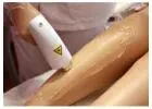 Laser Hair Removal Treatment