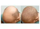 Hair Transplant Treatment