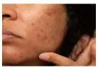 Melasma Hyperpigmentation in