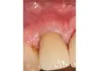 Same-Day Tooth Replacement for Faster Smile Recovery