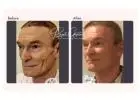 Facelift Surgery Cost In Delhi NCR - Dr Rajat Gupta