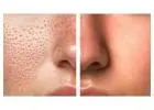 Open Pores on Face