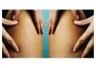 Stretch Mark Removal Treatment
