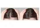 Exosome Hair Treatment