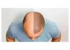 Hair Transplant Treatment
