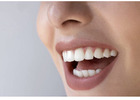 Tooth Color Fillings Auckland