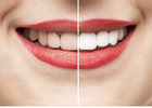 Teeth Whitening in Mount Roskill, Auckland